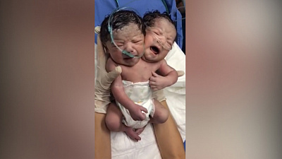 Двуглавый младенец взорвал интернет