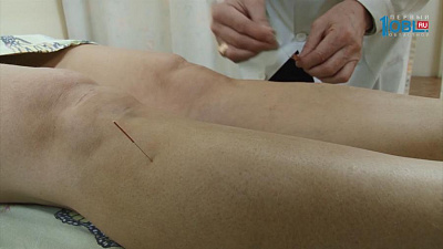 Лечение артроза методами рефлексотерапии