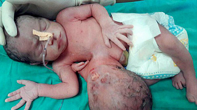 Младенца со второй головой в животе сняли на видео