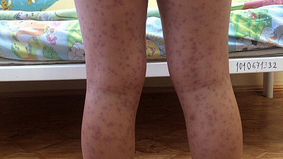 После жалоб купальщиков на сыпь Роспотребнадзор признал воду в Тургояке безопасной