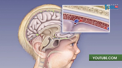 Как избежать менингита 