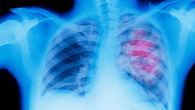 Пневмония возглавила рейтинг болезней, которыми страдают россияне