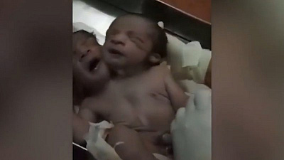 Ребенок с двумя головами прожил лишь сутки после своего рождения 