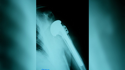 Челябинские врачи впервые поставили протез плечевого сустава 