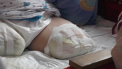 Врачи выписали пенсионерку с торчащей костью и не зажившими ранами после ампутации ног