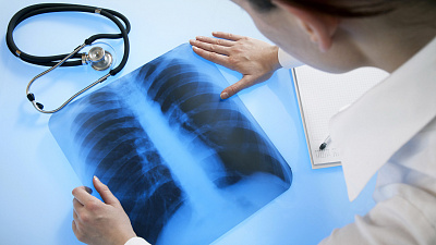 Диагностика туберкулеза сократилась до трех дней на Южном Урале