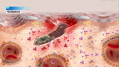 В доме престарелых вспыхнул очаг чесотки